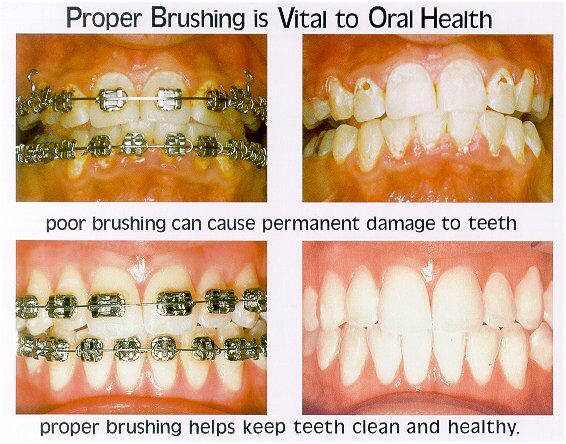 Bad Teeth From Not Brushing With Braces