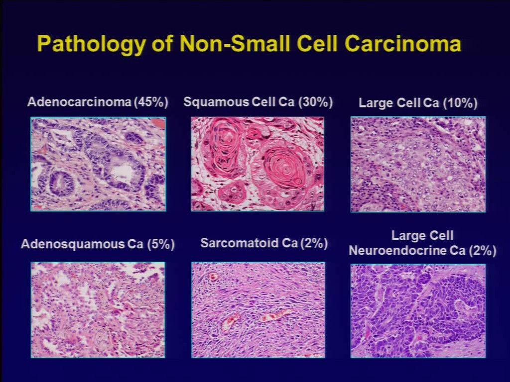 Squamous Cell Carcinoma Lung Histology