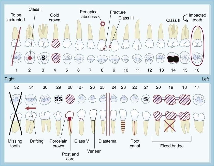 Dental Charting Symbols | World Of Template & Format throughout Dental