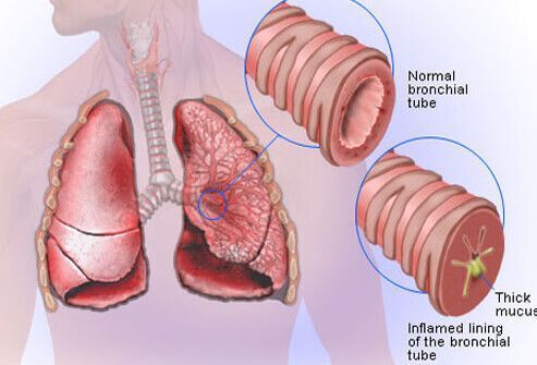 Picture of Acute Bronchitis | Home remedies for bronchitis, Asthma ...