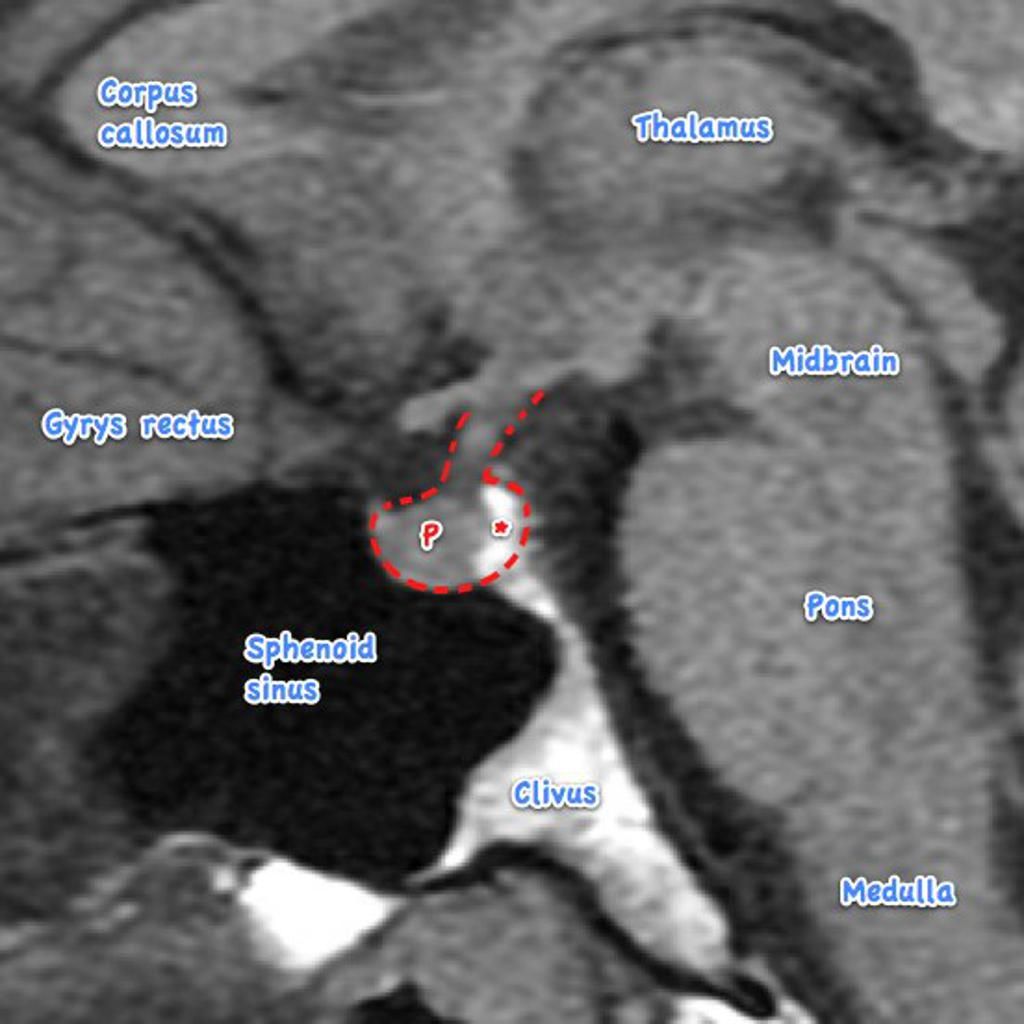 Pituitary MRI - normal study | Radiology Case | Radiopaedia.org ...