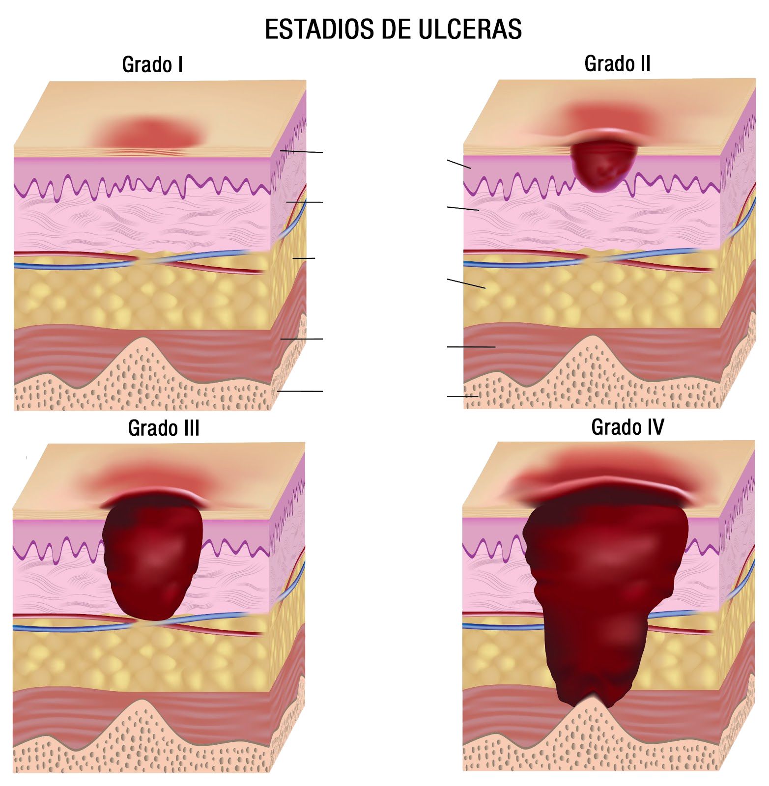 Staging Of Pressure Ulcers Bed Sores - Gambaran