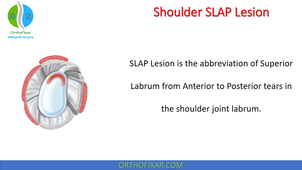 Biceps tendon tears and slap lesions – Artofit