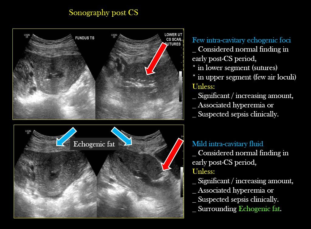 Abnormal Ovary Ultrasound