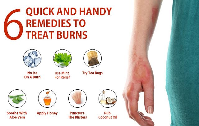 Home remedies for burns - bayhety