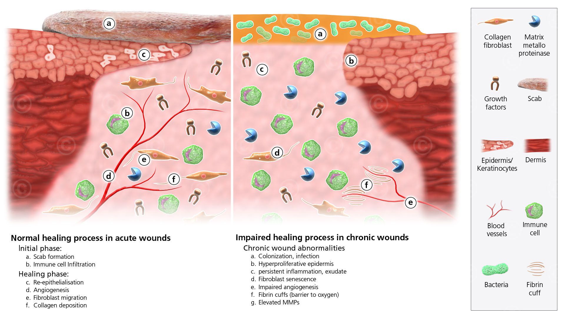 Stages Of Wound Infection