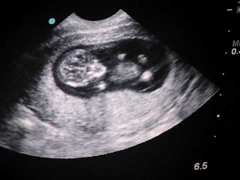 Baby's First Ultrasound 11 weeks 1 day | First ultrasound, Boy ...