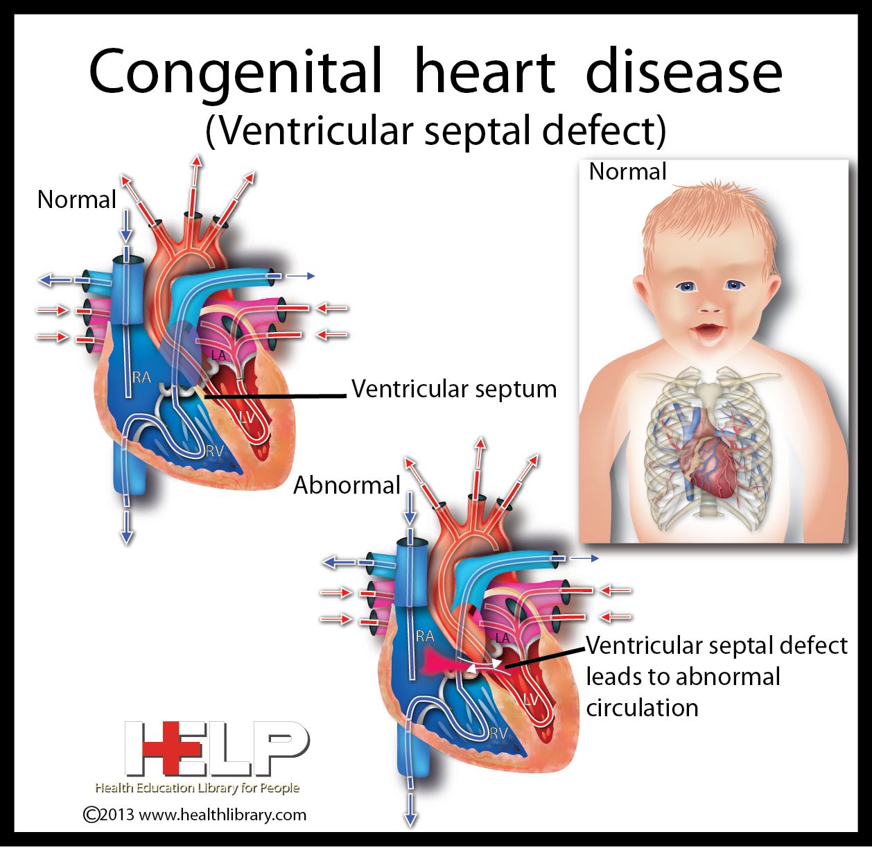 Congenital Heart Defects Diagram