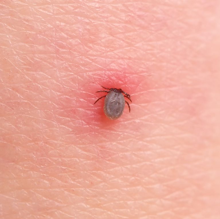 How to Treat a Tick Bite the Right Way, According to Dermatologists in ...