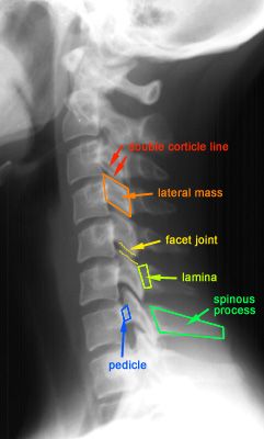 spinous process cervical fracture - Google Search | Radiology student ...