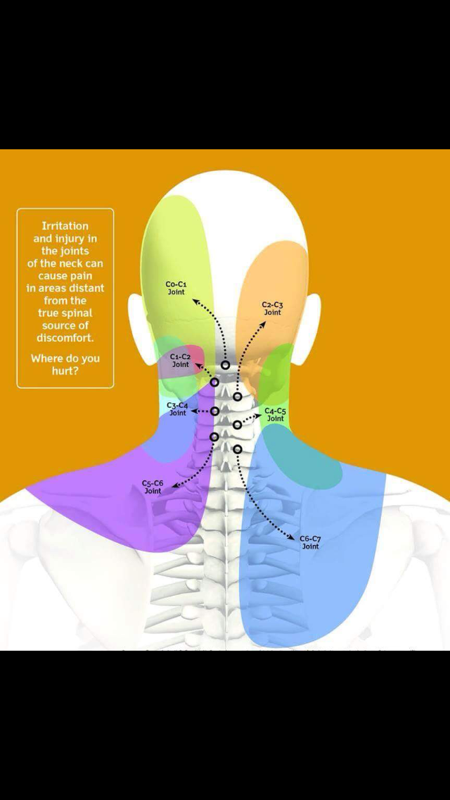 Occipital nerve block injections for occipital neuralgia migraines ...