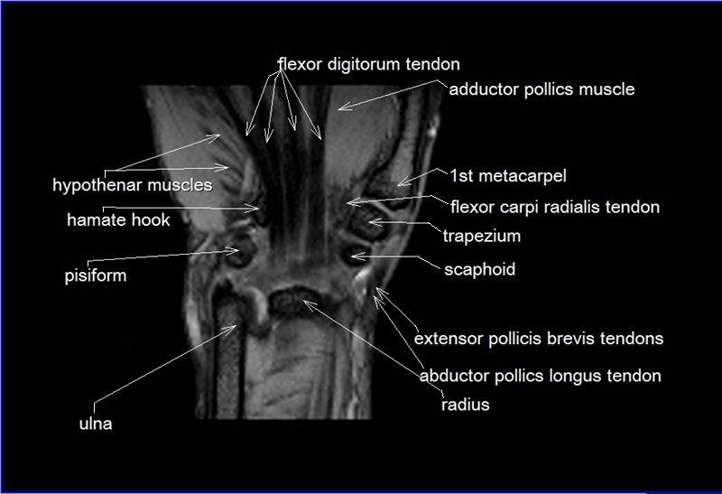 Wrist Anatomy Mri Wrist Axial Anatomy Free Cross Sect - vrogue.co