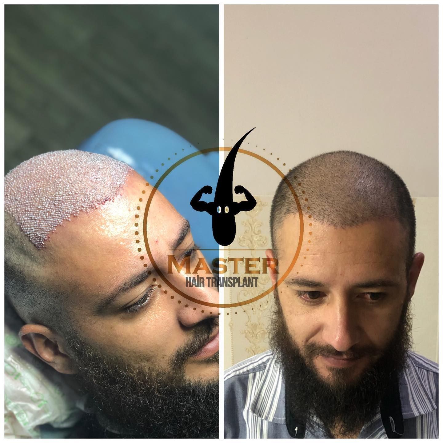 Stunning Transformation: 10-Day Hair Transplant Results! (Before/After)