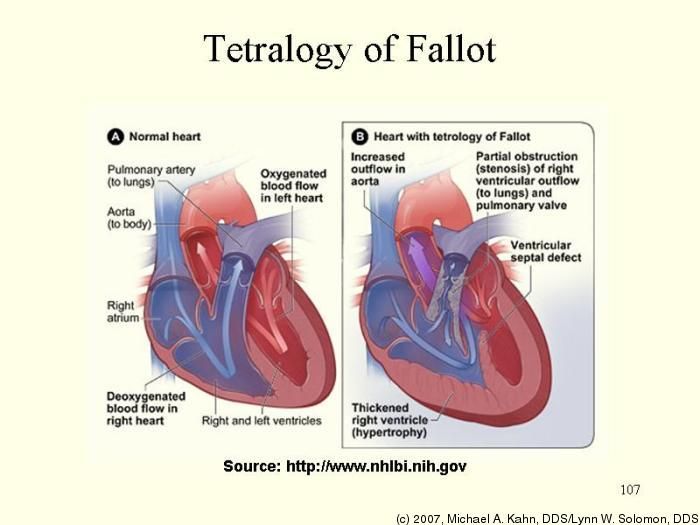 tetralogy of fallot | Tetralogy of Fallot | Atrial septal defect ...