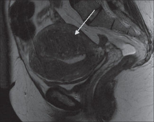 Adenomyosis Uterus MRI