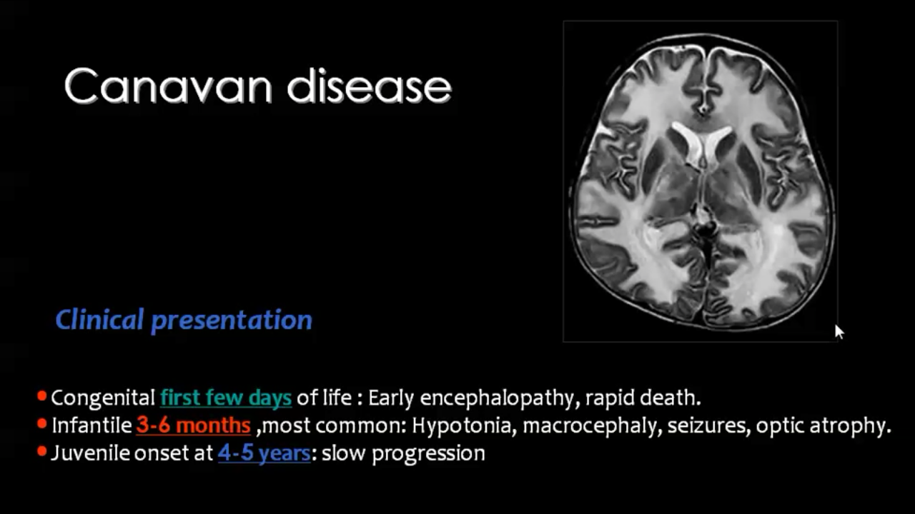 White matter diseases | A day in life, Neuropsychology, White matter