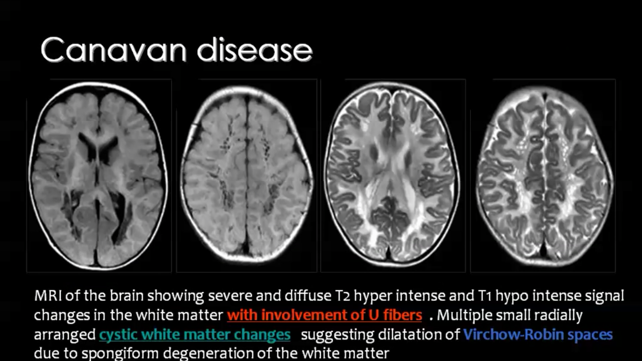 White matter diseases | White matter, Mri, Radiography