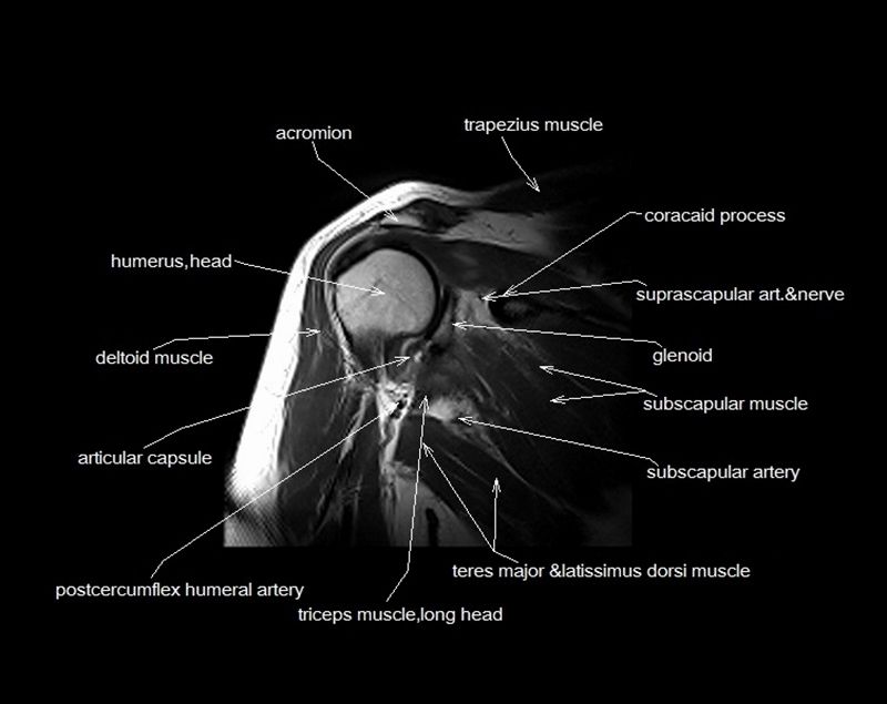 Conjoint Tendon Shoulder Anatomy Mri Musculo Skeletal - vrogue.co