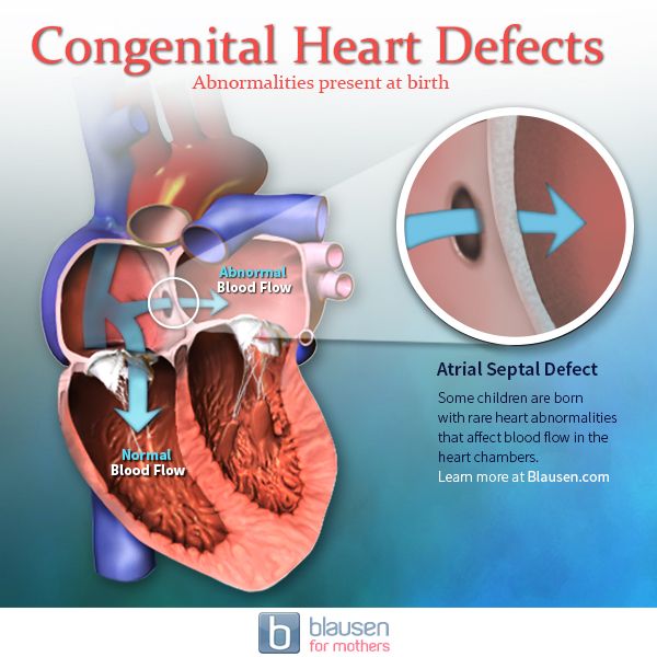 Congenital Heart Defects In Children Types Causes Sym - vrogue.co