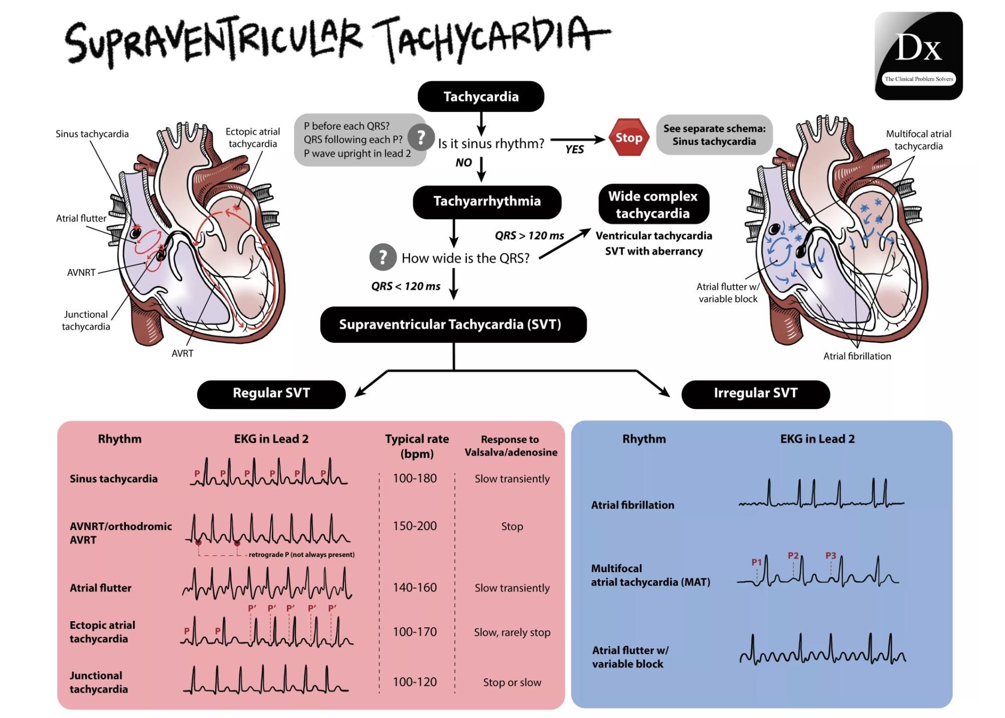 Supraventricular Tachycardia #SupraventricularTachycardia ... Nursing ...