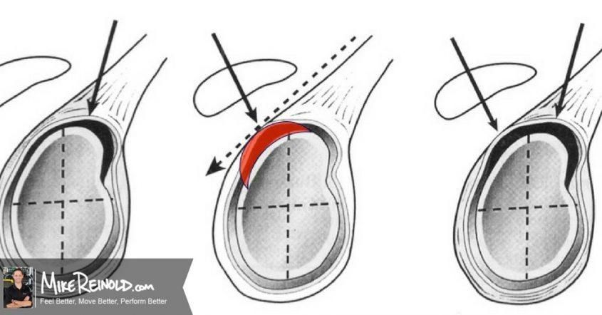 What Exactly Is a SLAP Tear? Top 5 Things You Need to Know Shoulder ...