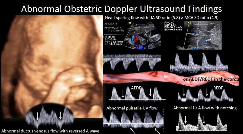 Fetal ultrasound heart rate | Ultrasound, Ultrasound sonography ...