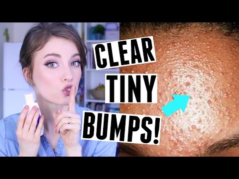 How To Get Rid Of Blackheads And Little Bumps On Face - HOWOTREMVO