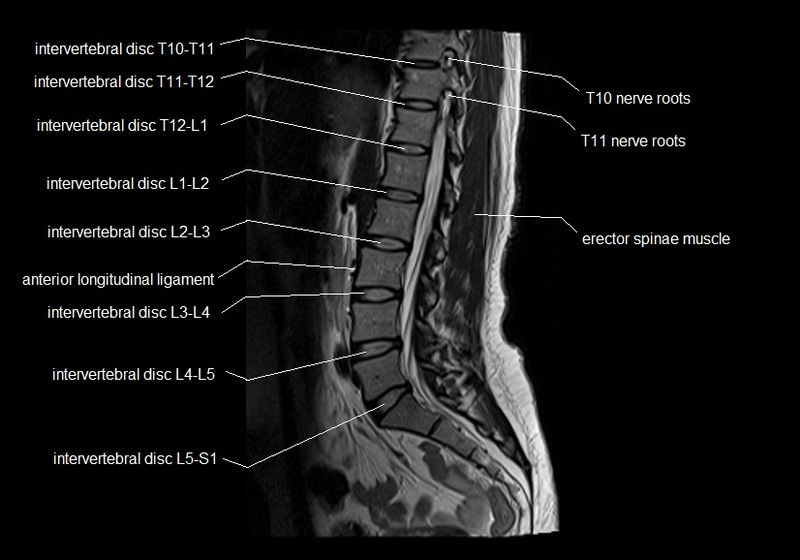 MRI spine anatomy | free MRI lumbar spine sagittal cross sectional ...