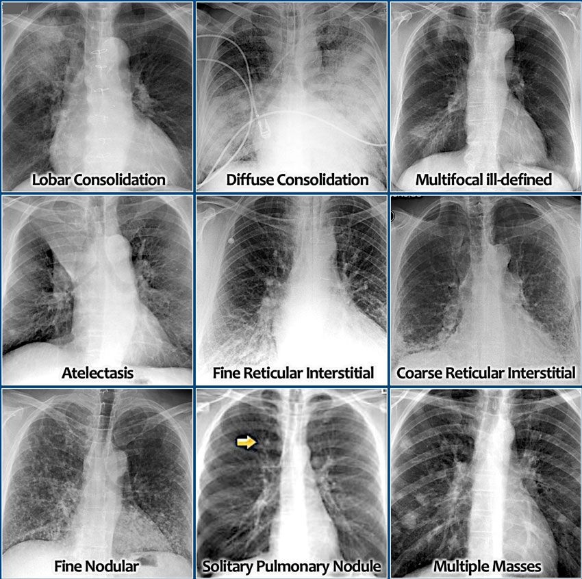 Pin by Stelios Daskalogiannis on THORAX | Medical imaging, Respiratory ...