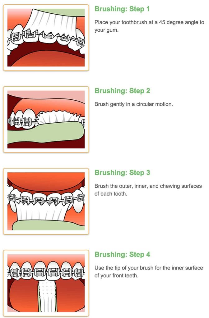 how to brush your teeth with braces - Google Search Braces Food, Braces ...