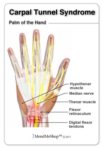 Pin on Wrist pain