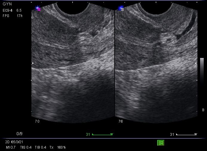 Cervical Polyp On Ultrasound