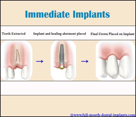 Pin by Jamie Bryant on Getting My Smile Back! | Dental implants, Teeth ...