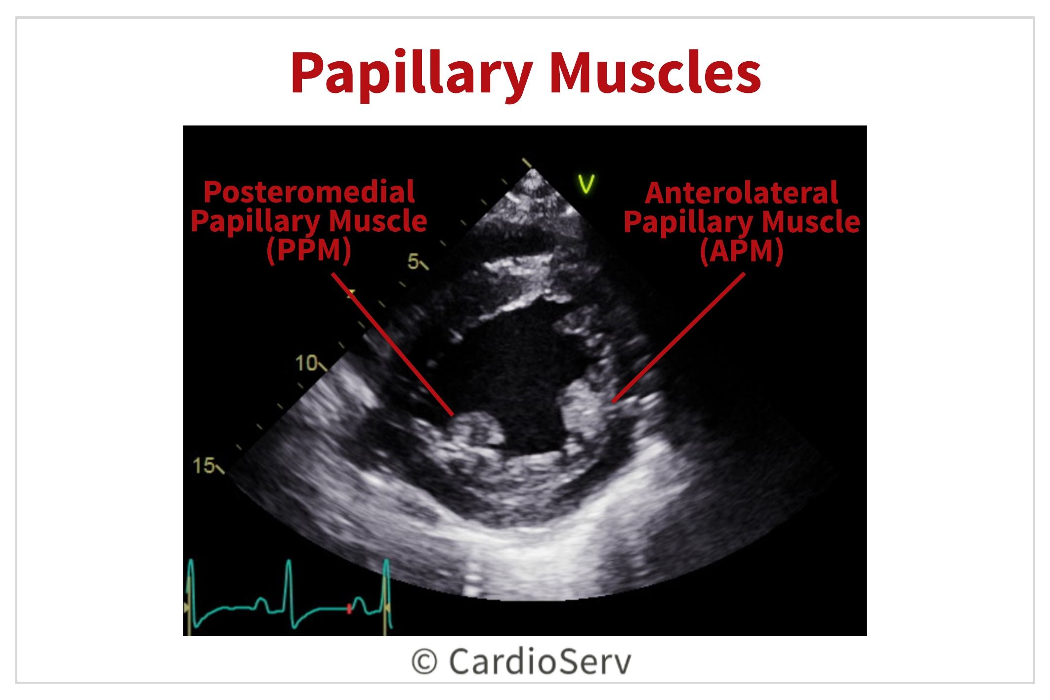 Papillary Muscles Echo Mitral Valve Cardiac Anatomy, Cardiac Sonography ...