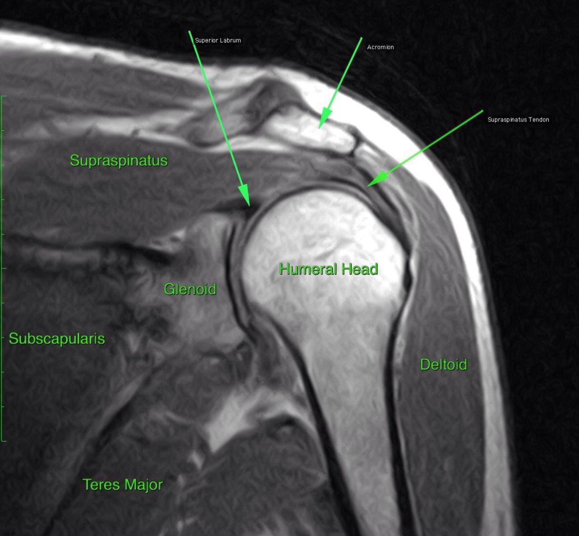 Shoulder Joint Anatomy Mri