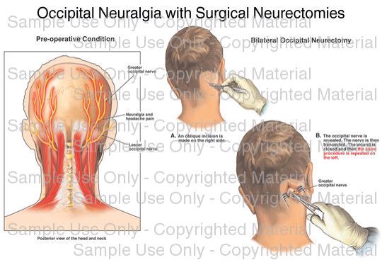 Occipital Neuralgia - Surgical Neurectomies | Occipital neuralgia ...