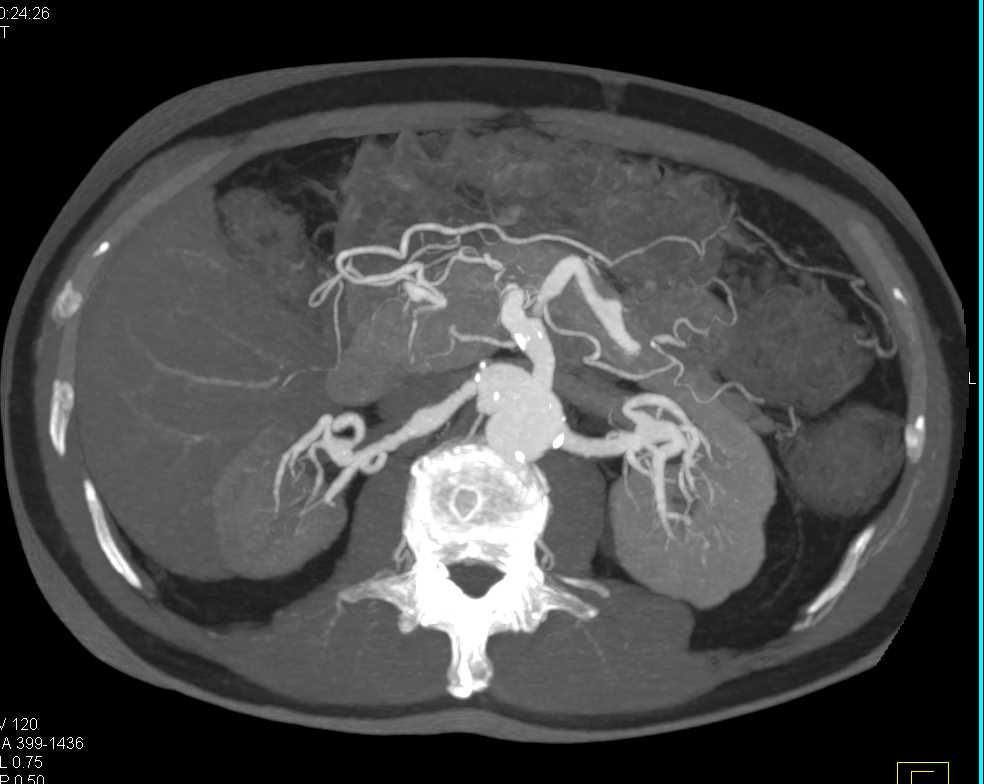 Celiac Artery Dissection and Vasculitis / CTisus.com Celiac Artery ...