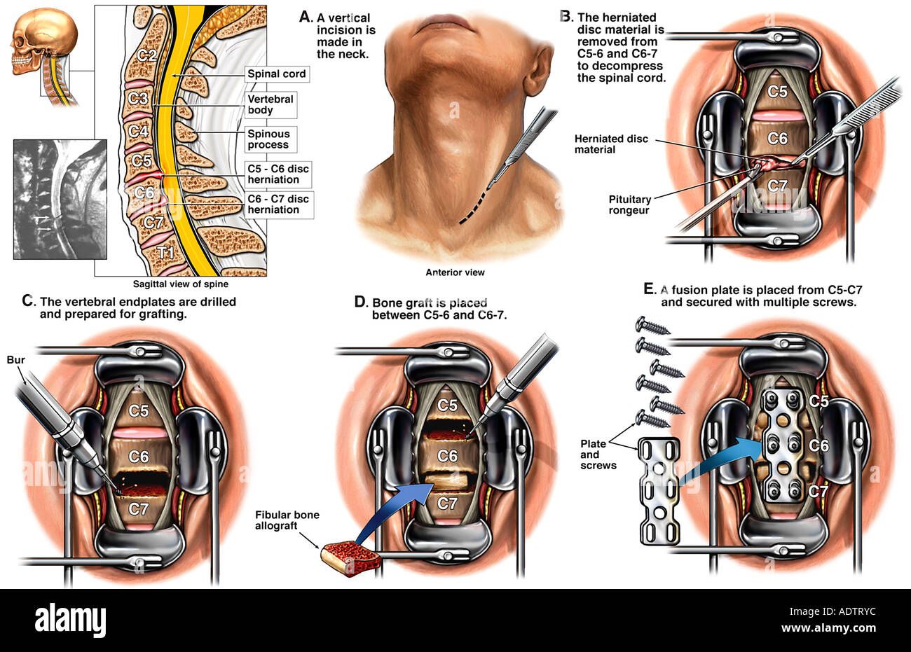 Download this stock image: Spine Surgery - C5-6 and C6-7 Anterior ...