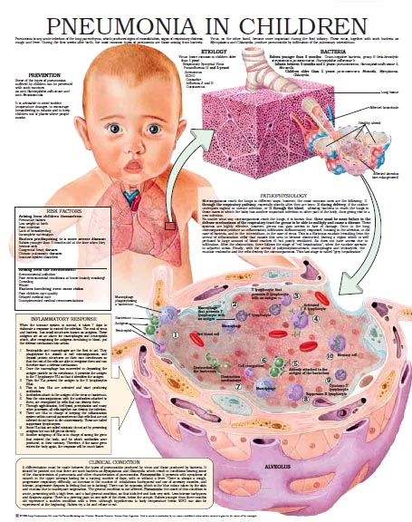 Pneumonia in children – Anejo Nurse Study Notes, Nursing Study ...