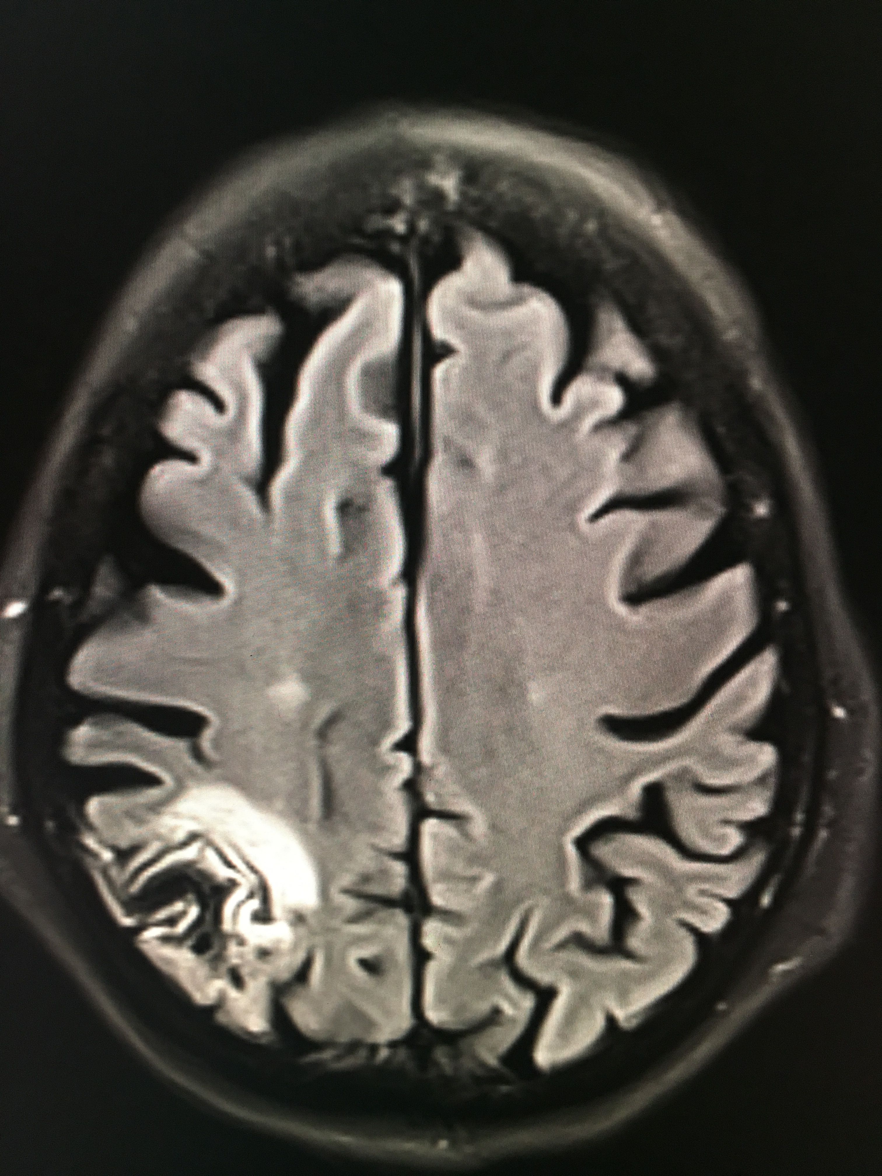 Cortical laminar necrosis | Imagenologia, Cosas de enfermeria, Radiología