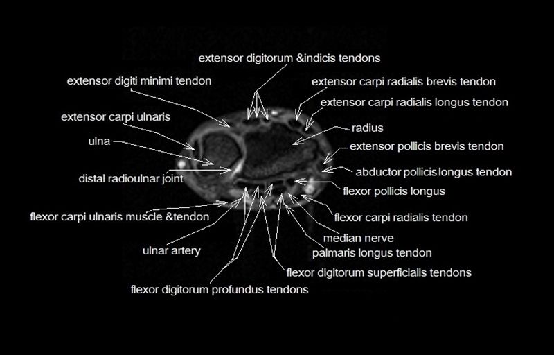 Wrist Tendon Anatomy MRI