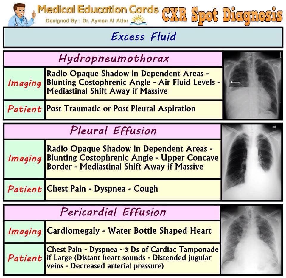 Pleural Effusion Types