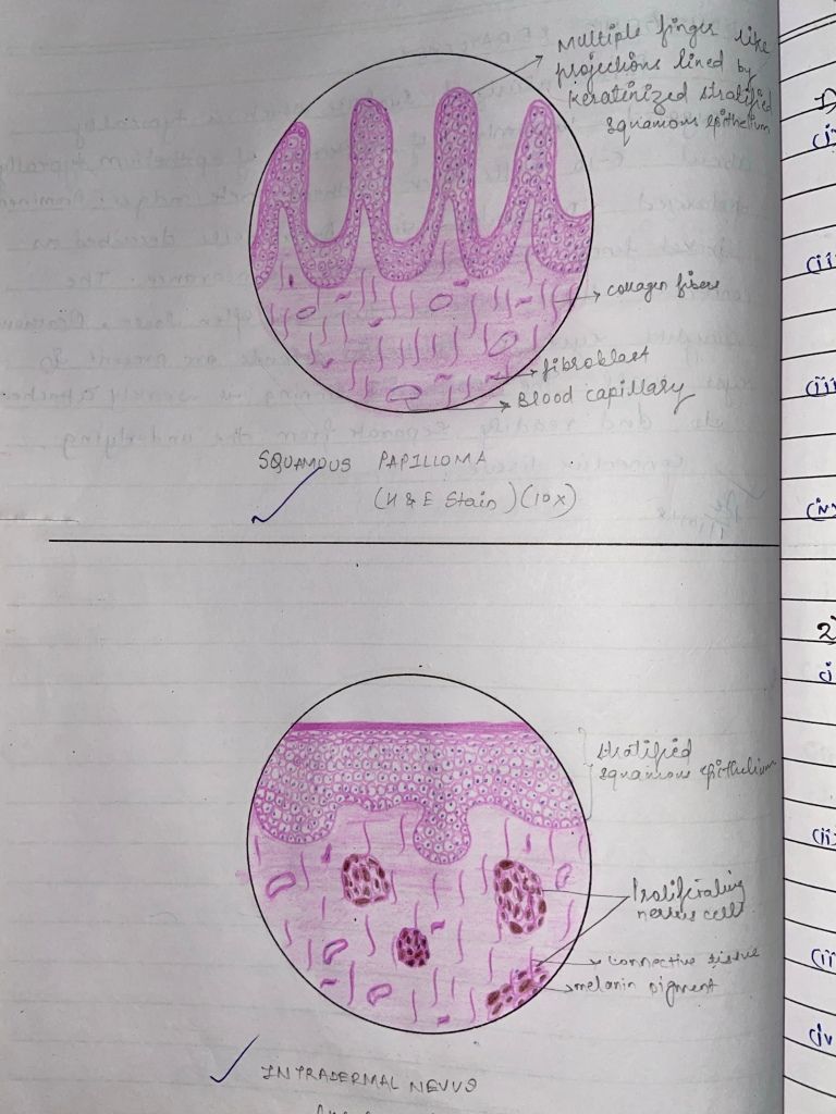 DIAGRAMS BENIGN AND MALIGNANT TUMOUR OF ORAL CAVITY I – Dentowesome in ...