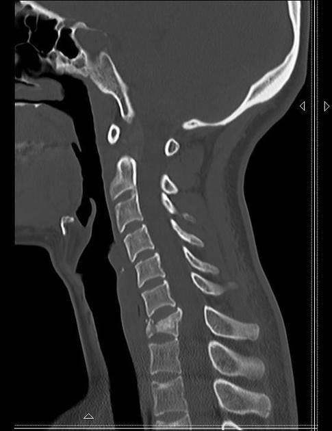 Hyperflexion cervical spine injury (flexion teardrop fracture ...