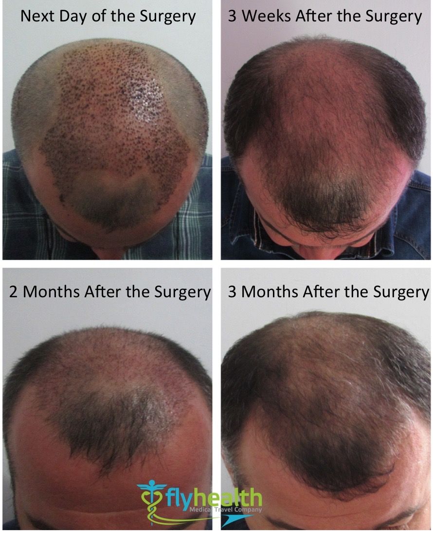 Hair Transplant Growth Timeline: How Your Head Looks After Hair ...