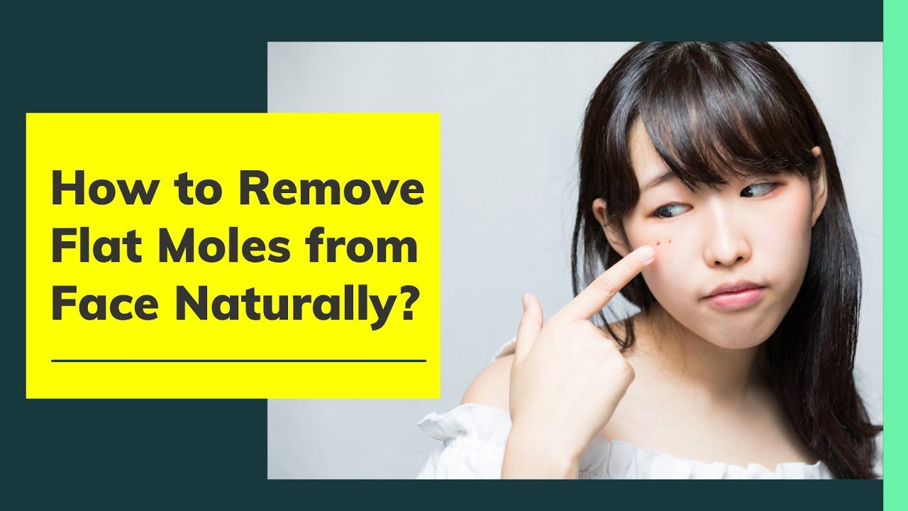 How to Remove Flat Moles from Face Naturally at Home - 7 Quick Tips ...