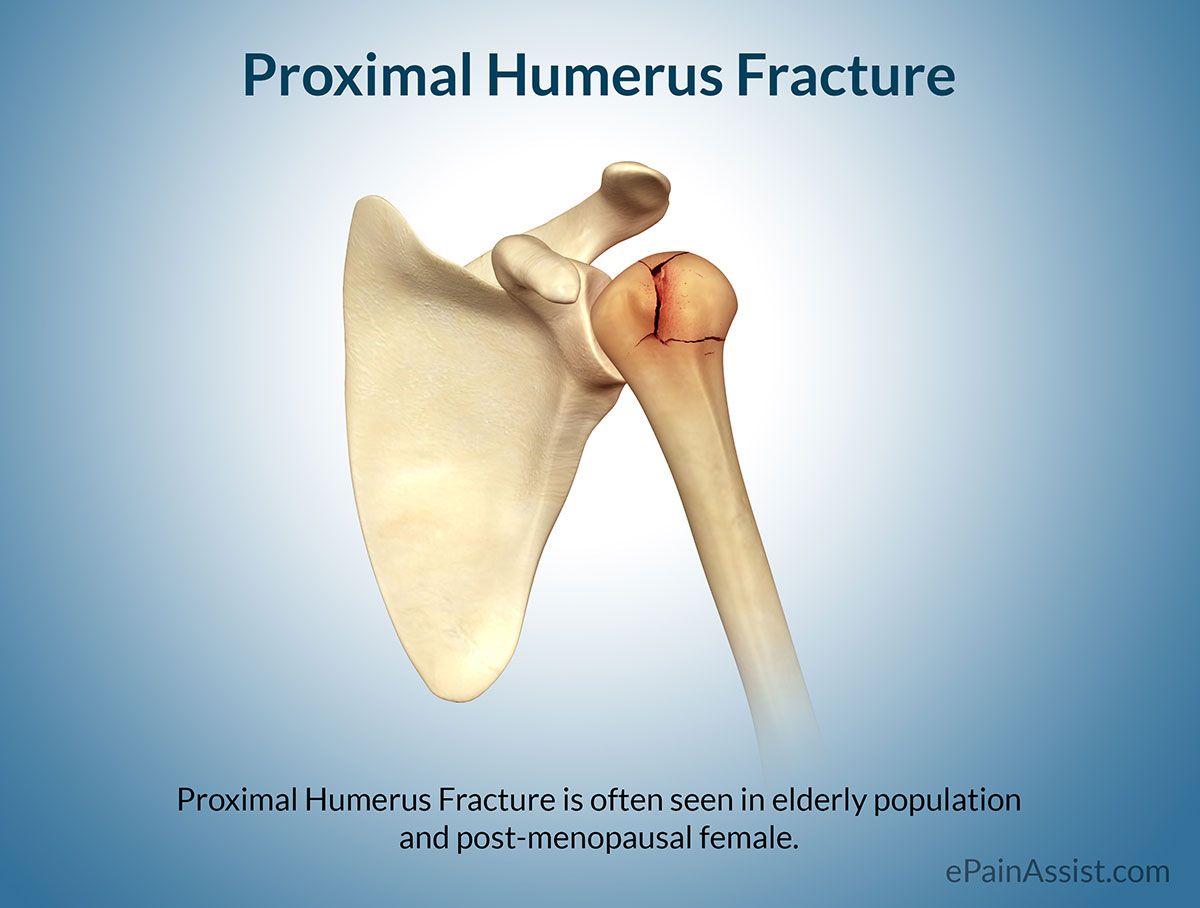 Pin by M. Jan Marshall on Let's Get in Shape | Humerus fracture, Bone ...