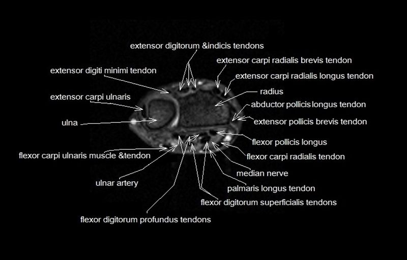 Wrist Tendon Anatomy MRI