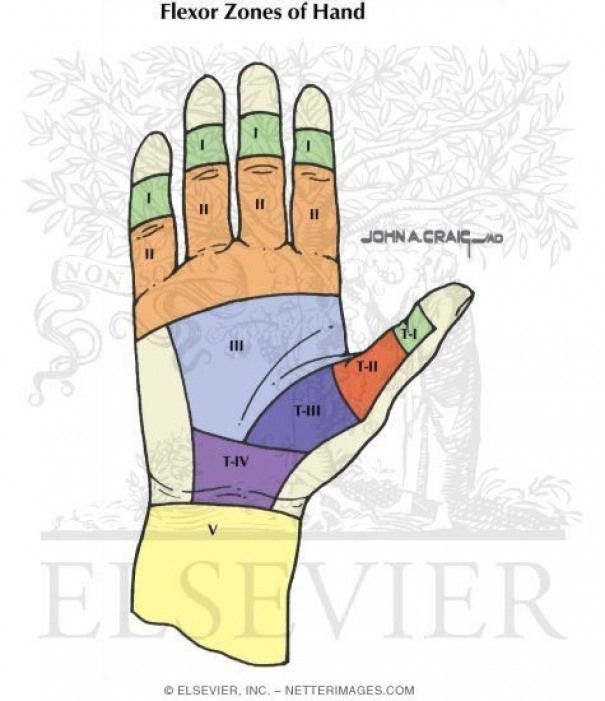 Flexor Tendon Injury Zones | Hand therapy, Occupational therapy, Injury