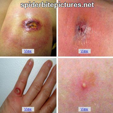 brown recluse bite pics | ... Bite Pictures | Pictures Of Brown Recluse ...